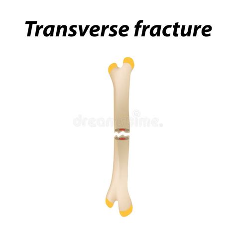 Bone Fracture stock vector. Illustration of body, disabled - 14779519