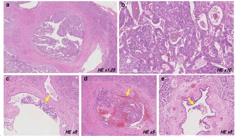 Histopathological Findings Of The Resected Specimens In The Second