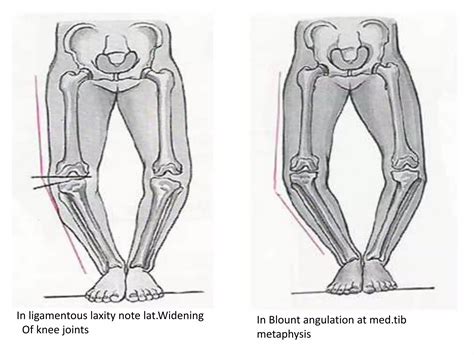 Genu Varum Genu Valgum Genu Recurvatum Ppt