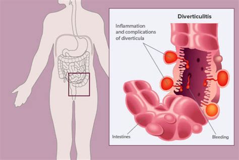 Diverticulitis Síntomas Y Tratamientos Serproen