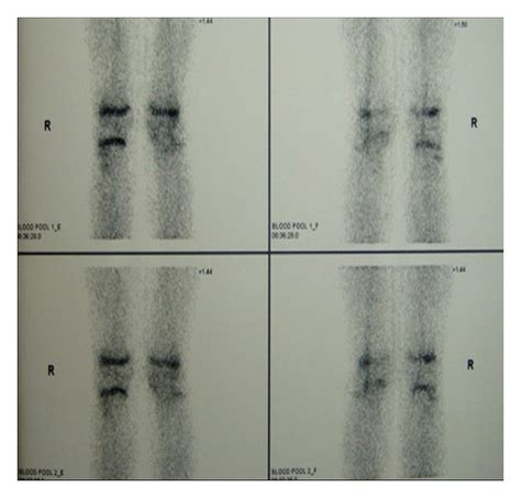 Bone Scanning With 99mtc Mdp Reduced Perfusion Of The Proximal Tibial