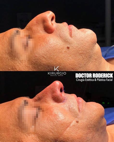 Rinoplastia Barcelona Kirurgio Medical Center