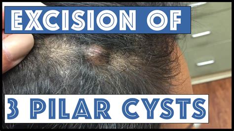 Epidermoid Cyst Scalp