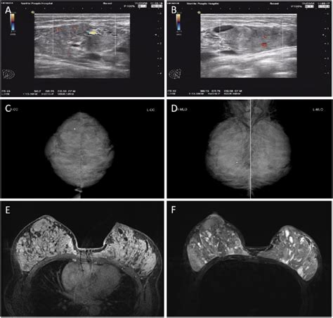 Preoperative Color Ultrasonography A B Mammography C D And Mri