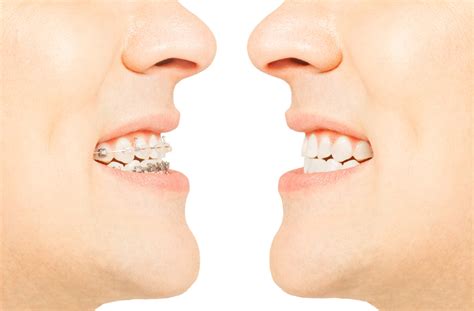 Choosing Between Invisalign And Traditional Braces