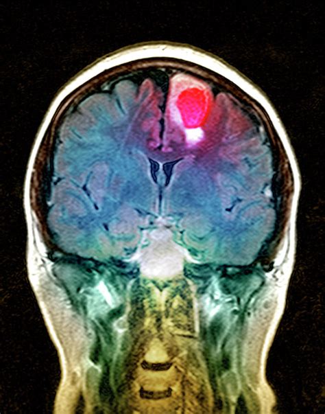 Brain Tumour Photograph By Simon Fraser Science Photo Library