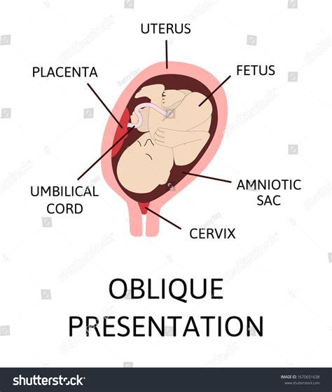 8 Head Position During Birth Images, Stock Photos & Vectors | Shutterstock