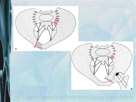 Pelvic fracture classification