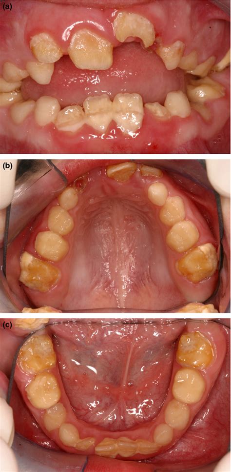 Teeth Genetic Diseases