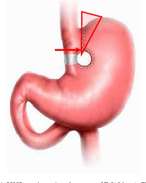 Vertical Banded Gastroplasty Before And After