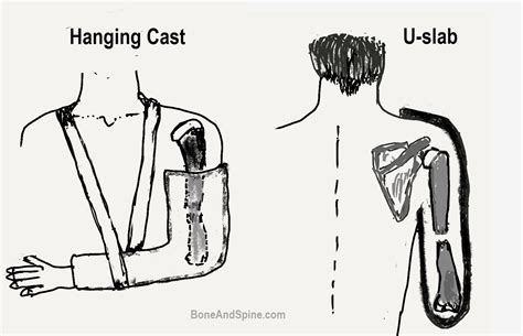 Proximal Humerus Fracture Cast