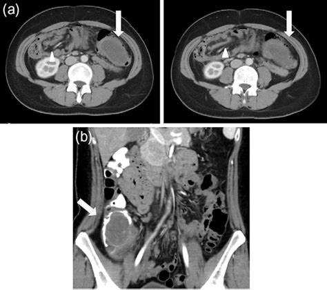 Figure 1 From Laparoscopic Operation After Pre Operative Reduction Of An Intussusception Induced