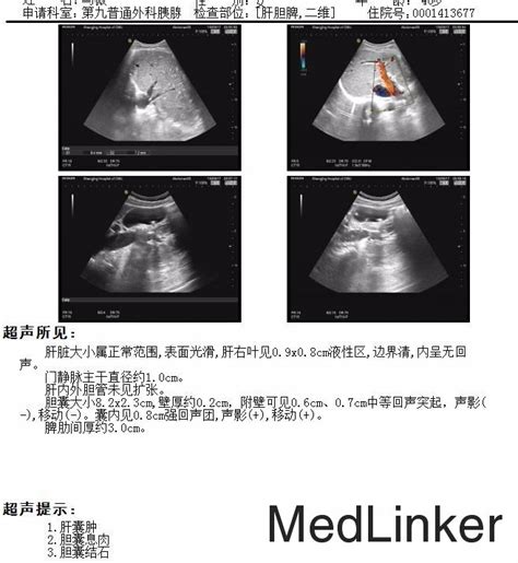 3D腹腔镜胆囊切除 医联