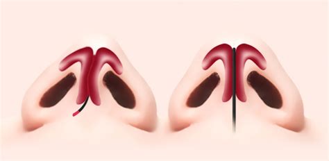 deviated nose functional rhinoplasty surgery korea  cdu