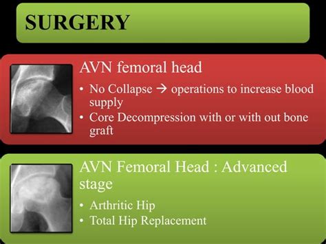 Avascular Necrosis Of Hip Avn Hip Ppt