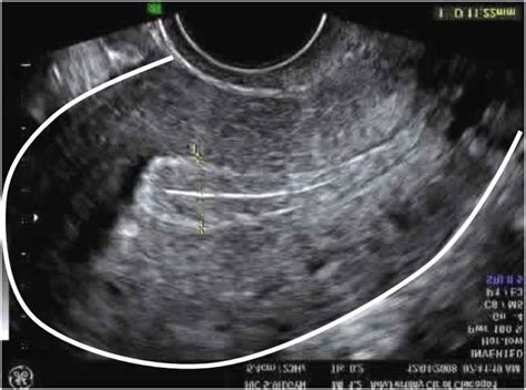 The AFA Blog Whats The Difference Between A Hysterosalpingogram HSG