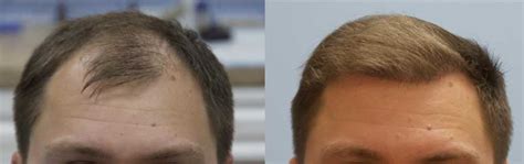 4000 Fue Graft Hair Transplant 2 Day Surgery Carolina Hair Surgery