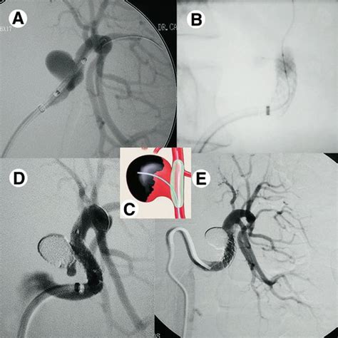 Balloon Assisted Coil Embolization A Selective Renal Artery