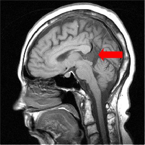 Brain MRI, Sagittal T1 showing incidental 17 mm pineal cyst | Download ...