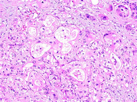 Pathology Outlines Ductal Adenocarcinoma NOS