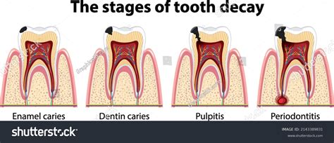 Stages Of Tooth Decay Over Royalty Free Licensable Stock Vectors