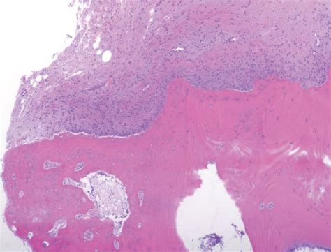 Histopathological Analysis Of The Resected Tumors Macroscopic Findings