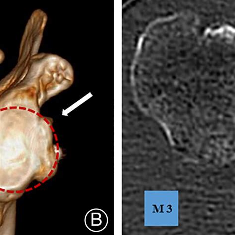 Screw Fixation And SutureButton Fixation For The Coracoid Graft A