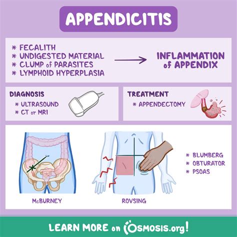 Osmosis From Elsevier On Twitter Appendicitis Is The Inflammation Of A Small Close Ended