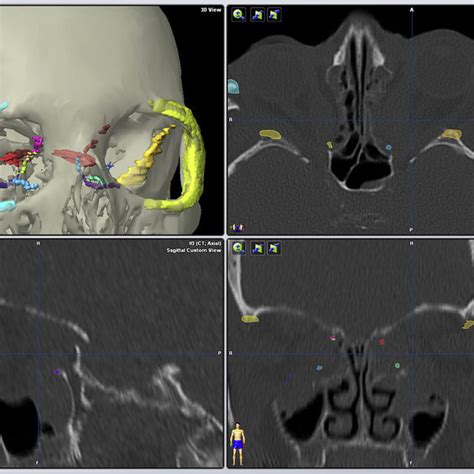 A Typical Preoperative Planning Situation With Display Of Resection Download Scientific Diagram