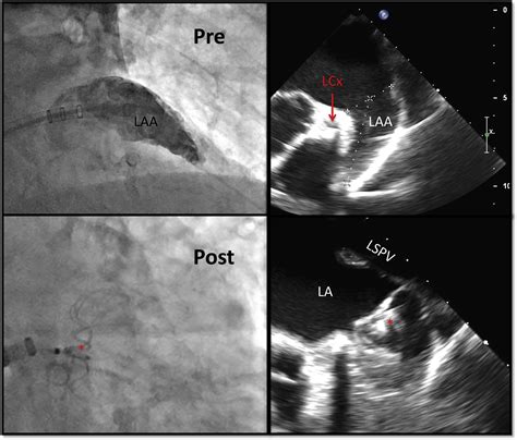 Left Atrial Appendage Exclusion For Atrial Fibrillation Heart Failure Clinics