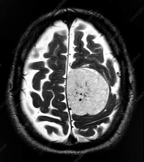 Parafalcine Meningioma MRI - Stock Image - C043/0276 - Science Photo Library