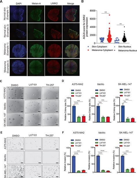 Limk2 Is Overexpressed In Melanoma Cells And Its Pharmacological