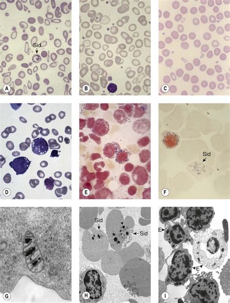 Sideroblastic Anemia Basicmedical Key