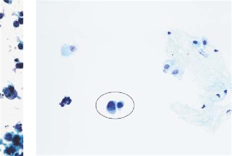 [PDF] Urine and bladder washing cytology for detection of urothelial carcinoma: standard test ...