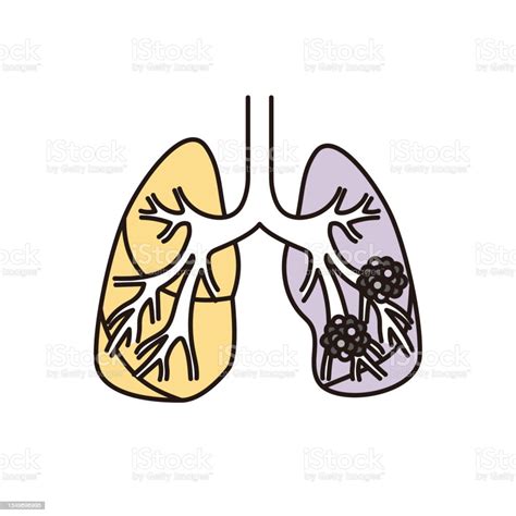 Lung Cancer Illustration Stock Illustration Download Image Now Lung