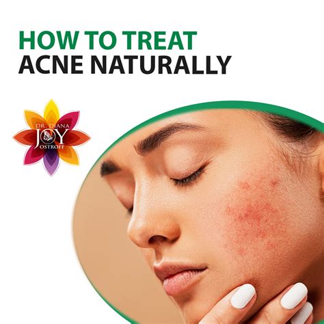 How to Treat Acne Naturally - Dr. Diana Joy Ostroff