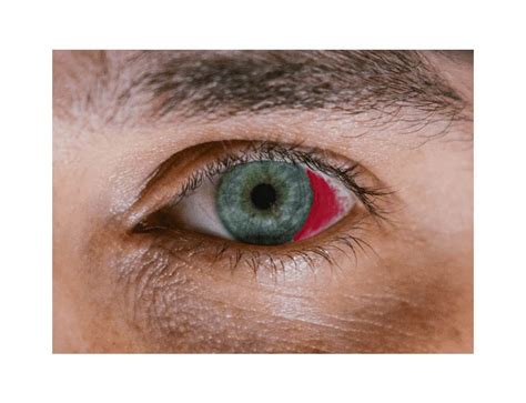 Subconjunctival Hemorrhage | Weber Vision Care