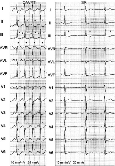 A patient with OAVRT with retrograde P waves in lead III and aVF ( Ã ),... | Download Scientific ...