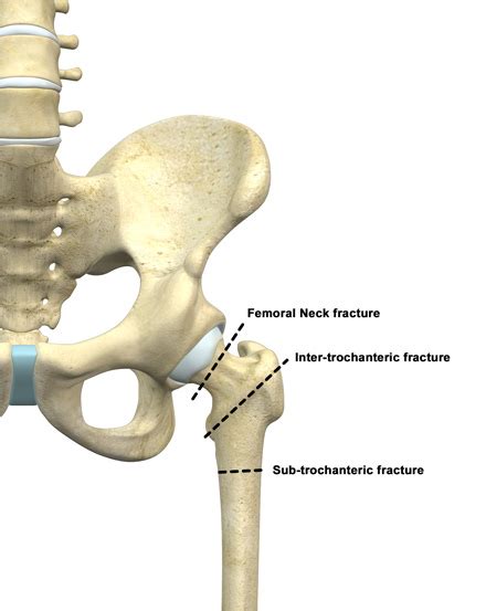 Hip Fracture Pottstown Montgomery County Pa Intracapsular Fracture Pa