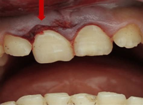 Bleeding At The Gingival Sulcus Download Scientific Diagram