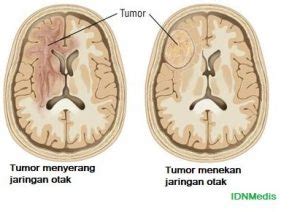 Kanker Otak A Z Penyebab Gejala Dan Pengobatan Idn Medis