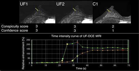 Background Parenchymal Enhancement And Its Effect On Lesion