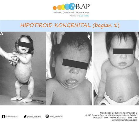 Hipotiroid Kongenital Klinik Anak AP AP Jakarta