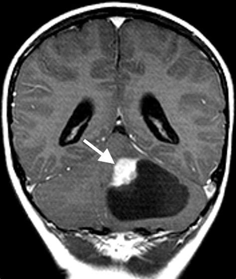 Primary Pediatric Posterior Fossa Tumors: An Illustrative Review - ARRS ...