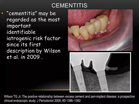 Periimplantitis | PPTX