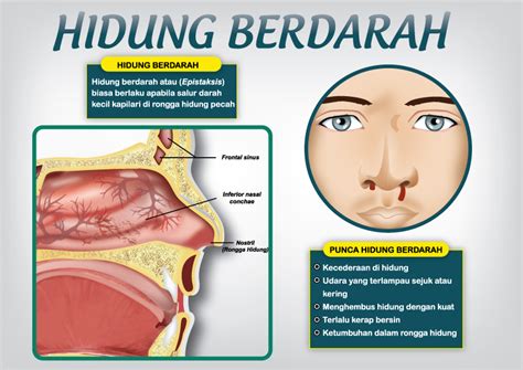 Penyakit Di Hidung Homecare24