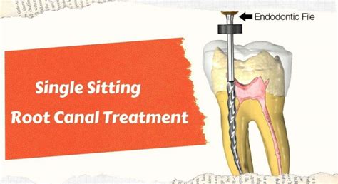 Single Sitting Root Canal Treatment Ganpati Dental Clinic