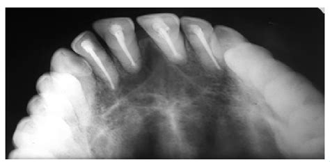 Radiograph Maxillary Occlusal View At Six Months Follow Up Showing