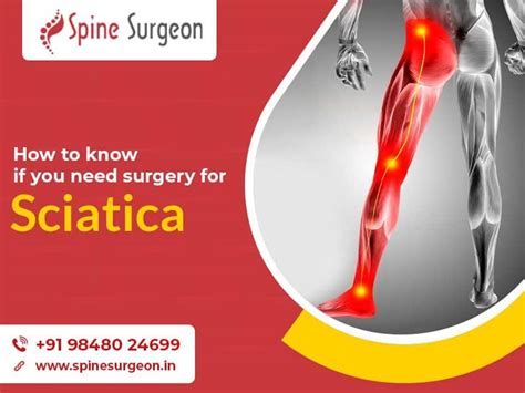 How To Know If You Need Surgery For Sciatica Spine Surgeon