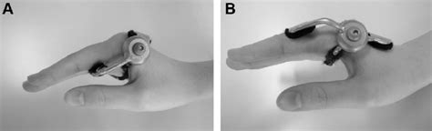 A Flexion Limitation Orthosis And B Extension Limitation Orthosis